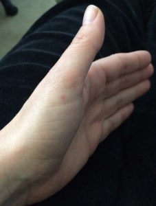 A spider bite or flea bite near my thumb.