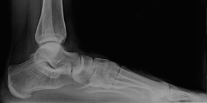 Left Foot X-Ray